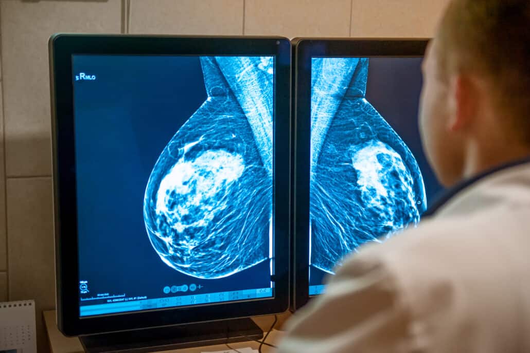 Früherkennung von Brustkrebs: Mammografiebilder auf dem Bildschirm