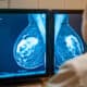 Früherkennung von Brustkrebs: Mammografiebilder auf dem Bildschirm