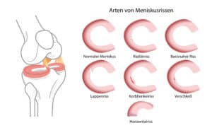 Verschleißbedingter Meniskusriss: Operieren Oder Nicht?