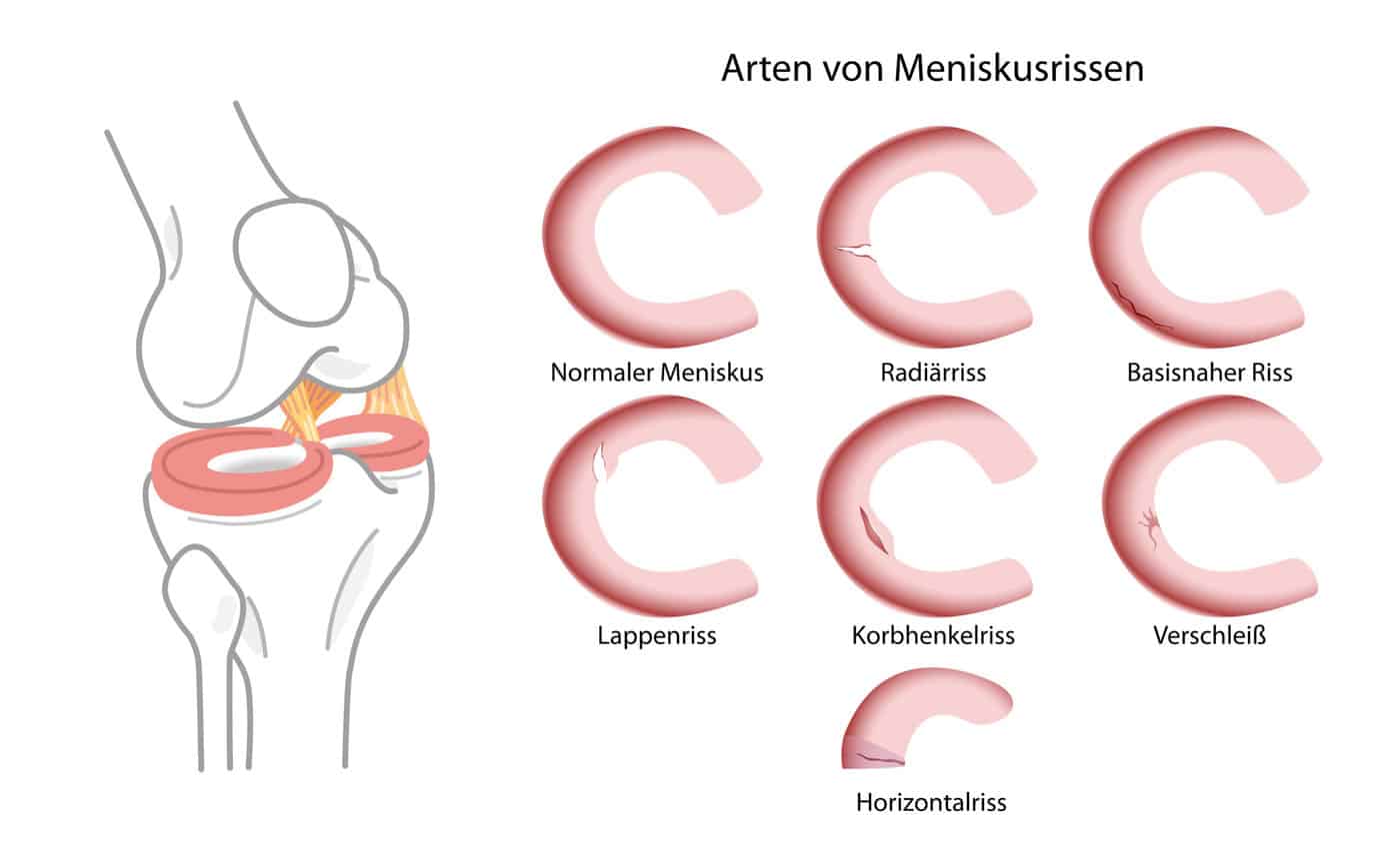 Verschleißbedingter Meniskusriss Operieren oder nicht?