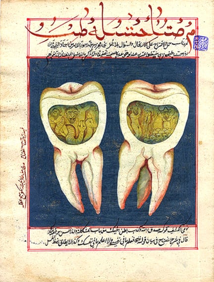 Zahnwurm, Abbildung aus einem zahnärztlichen Lehrbuch des 18. Jahrhunderts aus dem Osmanischen Reich