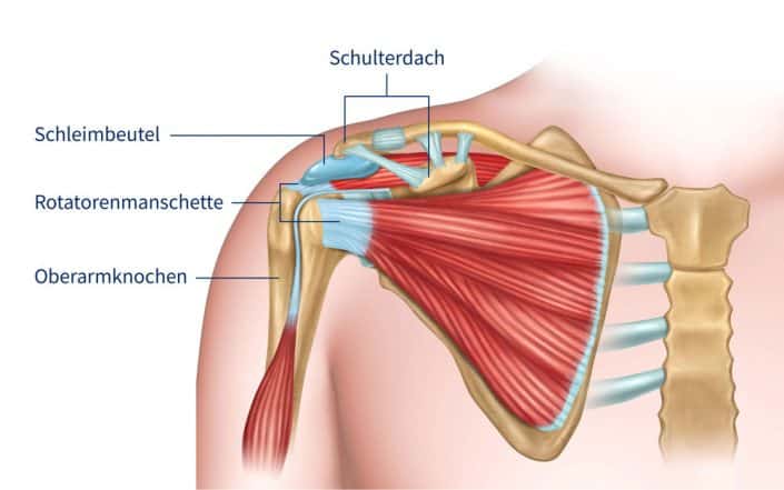 Impingement-Syndrom der Schulter - operieren oder nicht? • Wissen Was Wirkt